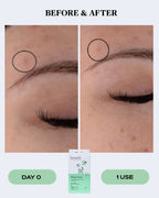 Advanced Transparent Pimple Patches for Fast Blemish Relief | CLEAR