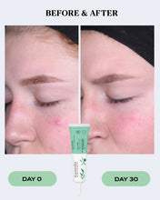 Load image into Gallery viewer, Pimple Relief Spot Treatment | CLEAR
