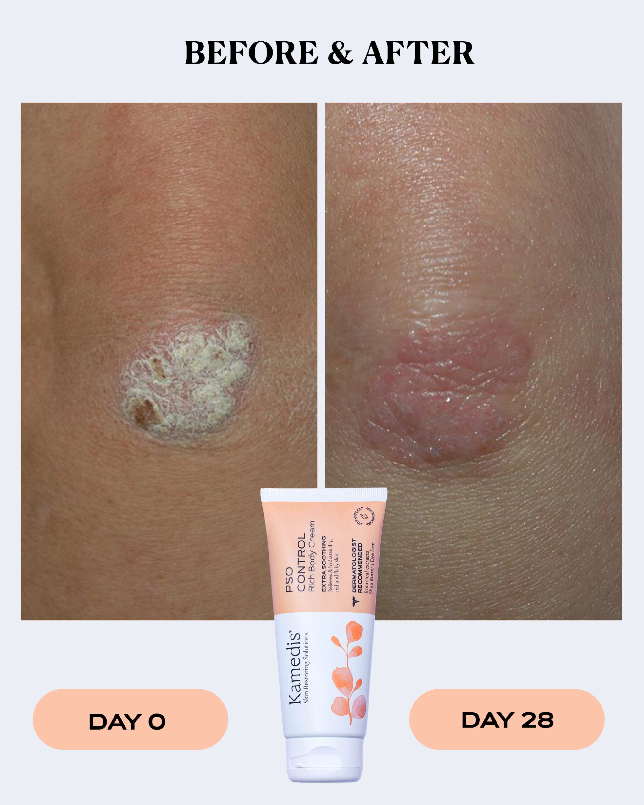 PSO CONTROL rich body cream – Multi-Symptom Relief for Dry & Flaky Skin
