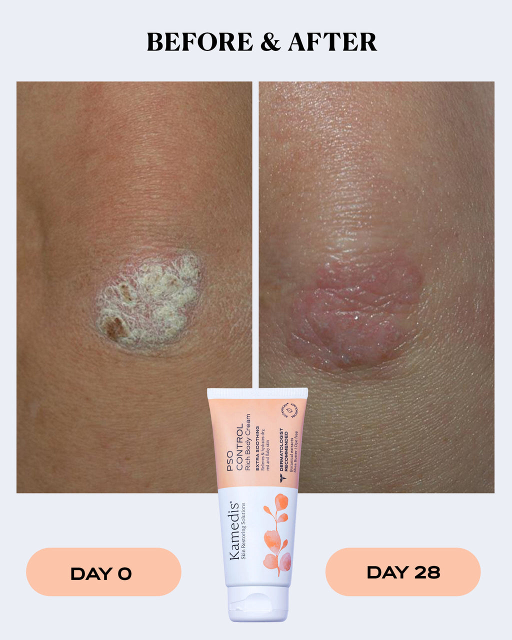 Rich Body Cream for Dry and Scaly Skin | PSO CONTROL