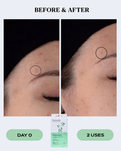 Load image into Gallery viewer, Advanced Transparent Pimple Patches for Fast Blemish Relief | CLEAR
