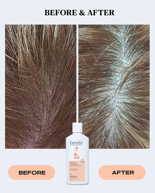 OTC Anti-Dandruff Shampoo | SCALP CONTROL