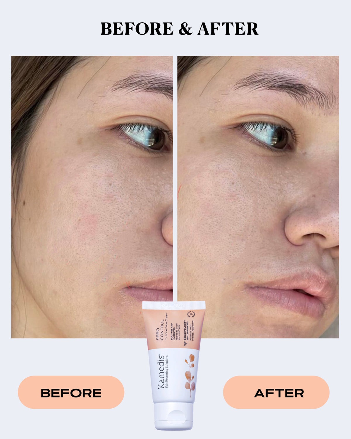 Redness Relief Cream | SEBO CONTROL